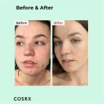 سرم BHA ضد جوش سرسیاه کوزارکس - Image 2